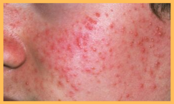 acne treatment in ayurveda