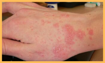 scabies treatment in ayurveda